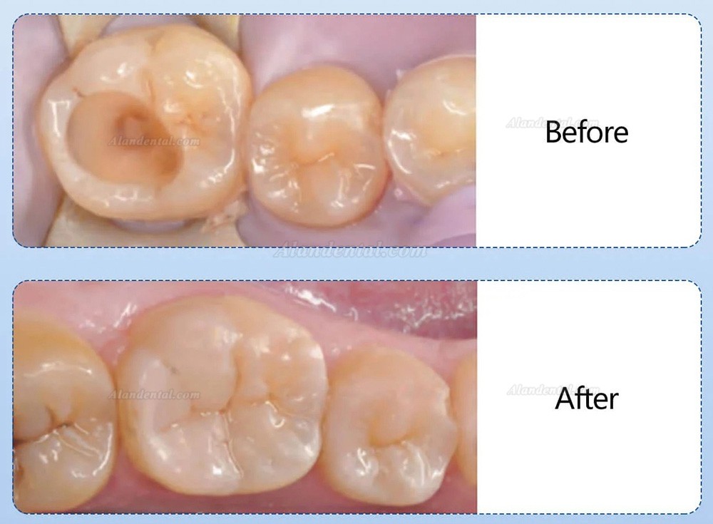 10 Capsule/Box A1/A2/A3/A3.5 Dental Composite Resin Light Cure Capsule